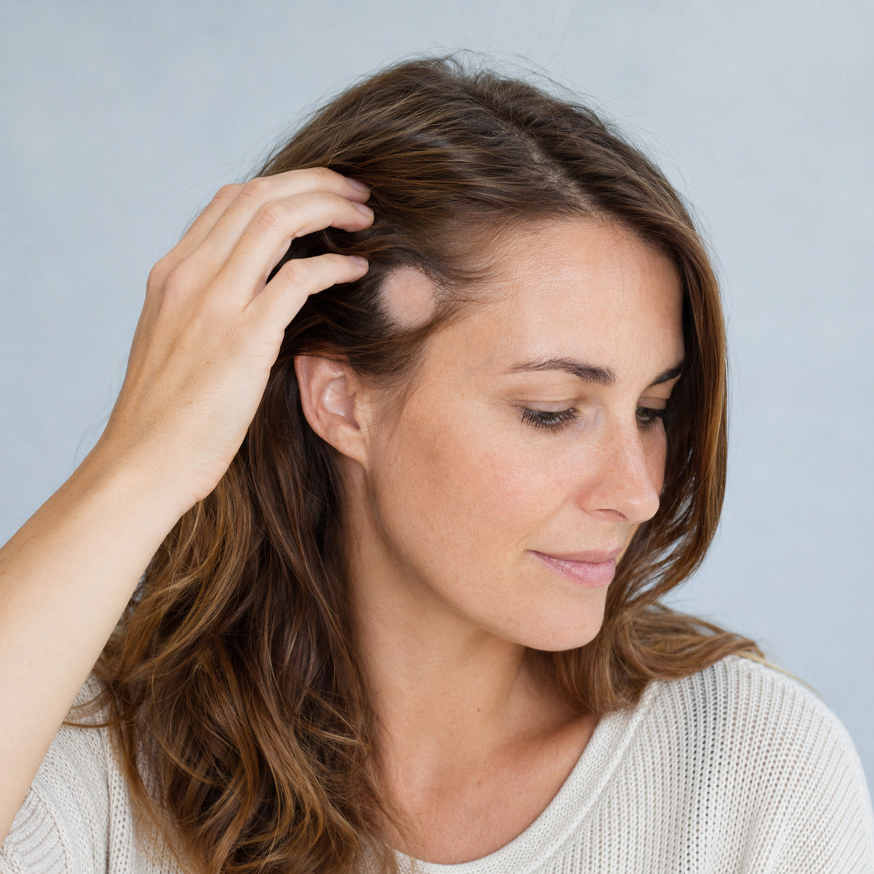 Vrouw toont een gladde ronde kale plek bij alopecia areata