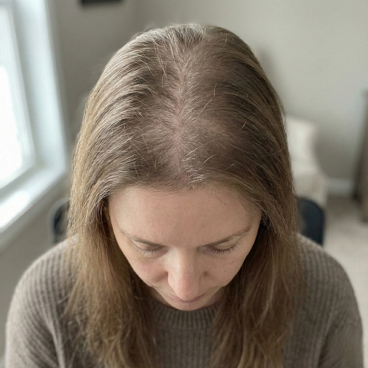 Diffuse hair loss in women